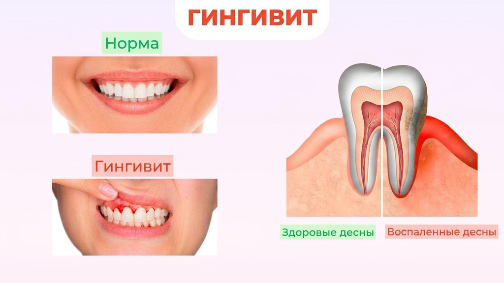 Лечение гингивита у детей