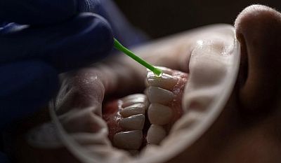 Зубной налет: почему появляется и как убрать